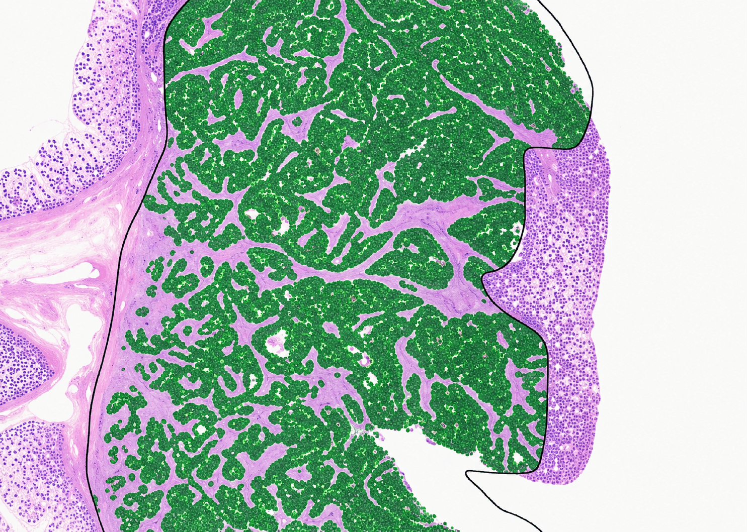 Identify tumor