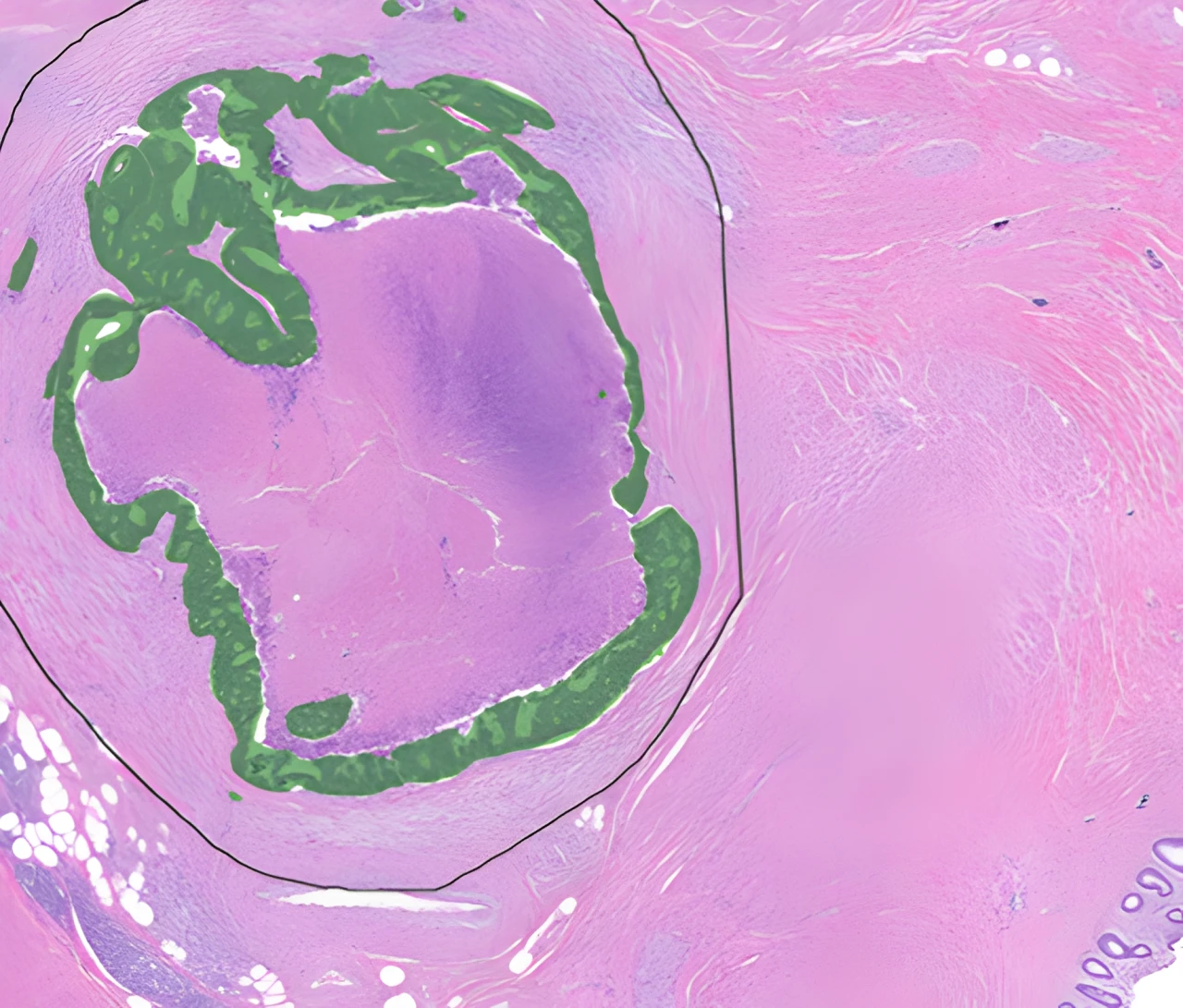 Tissue with the region of interest annotated by AI